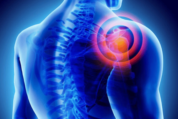 Shoulder Jam : Understanding the Condition and its Treatment